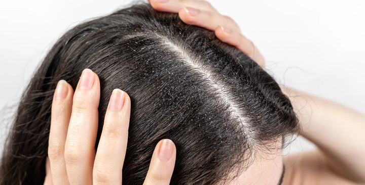 close up of lady with dandruff