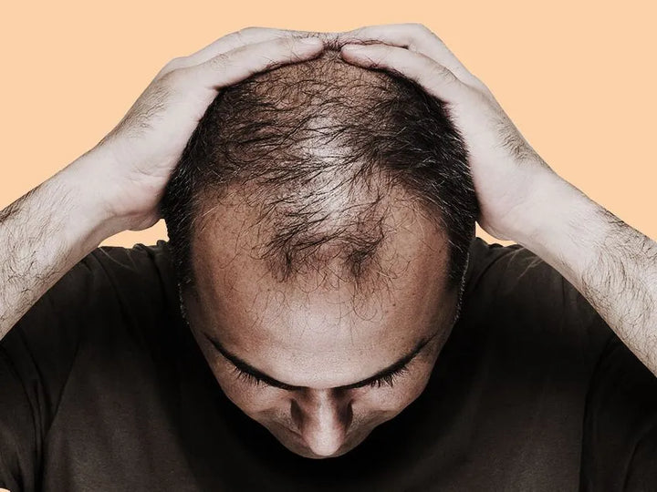 Solutions for Men's Hair Loss