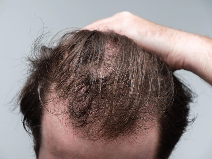 man brushing through his balding hair