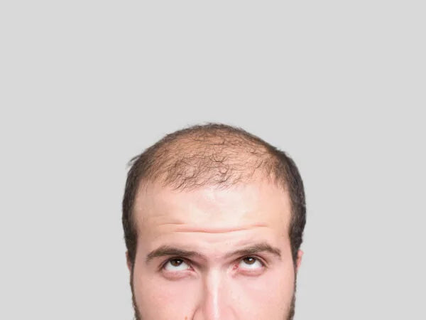 man looking at his balding head