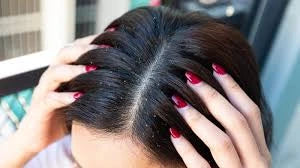 lady with dandruff in her hair